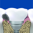 solo-med_2404-2409_zaehne-mit-solo-stix-i-04.webp